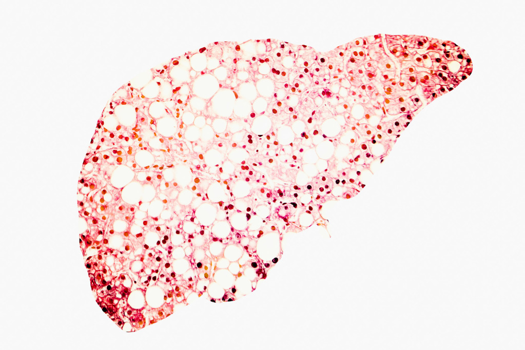 Fatty liver, conceptual illustration
