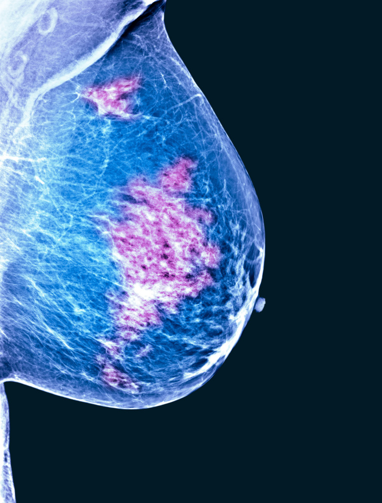 Breast cancer, X-ray