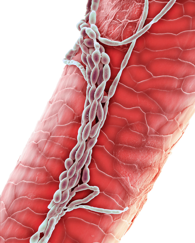 Fungal infection on eyelash, SEM