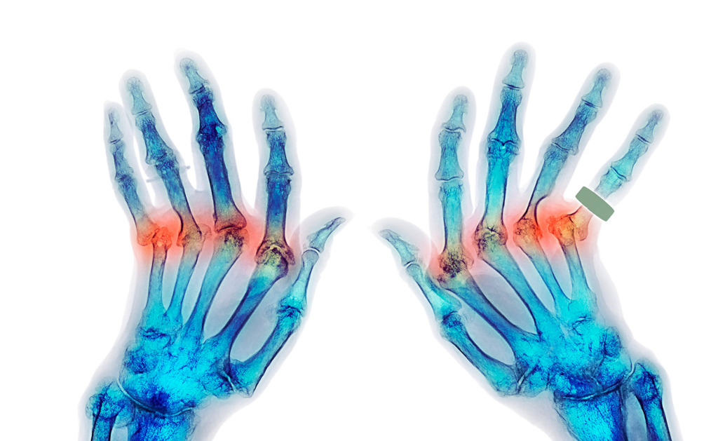 Rheumatoid arthritis, coloured X-ray