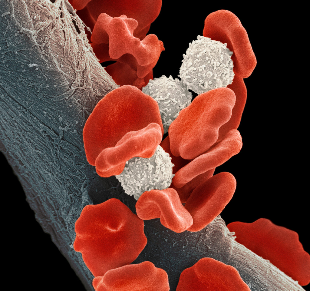 Leukaemia blood cells, SEM