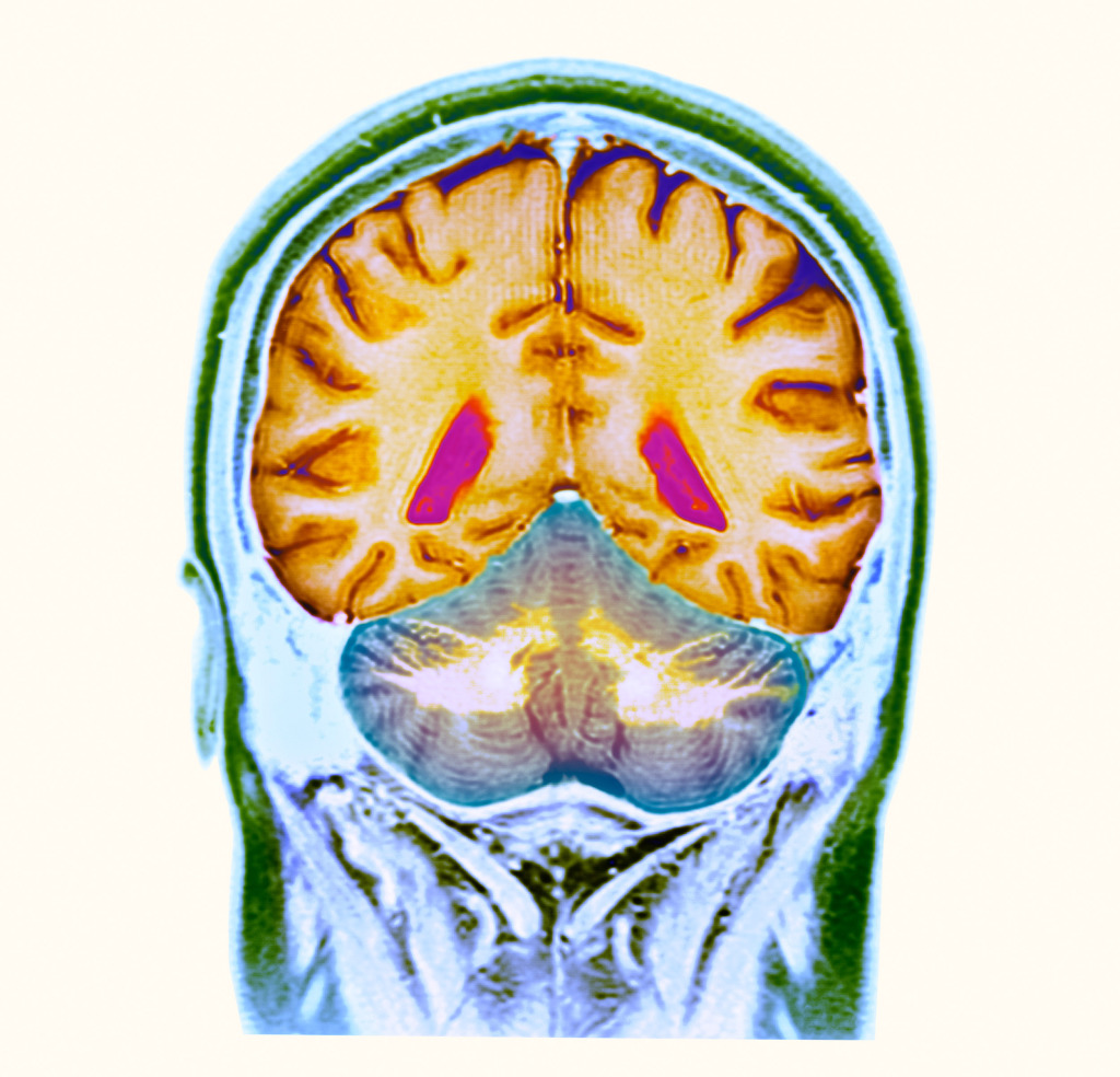 Healthy brain, MRI scan