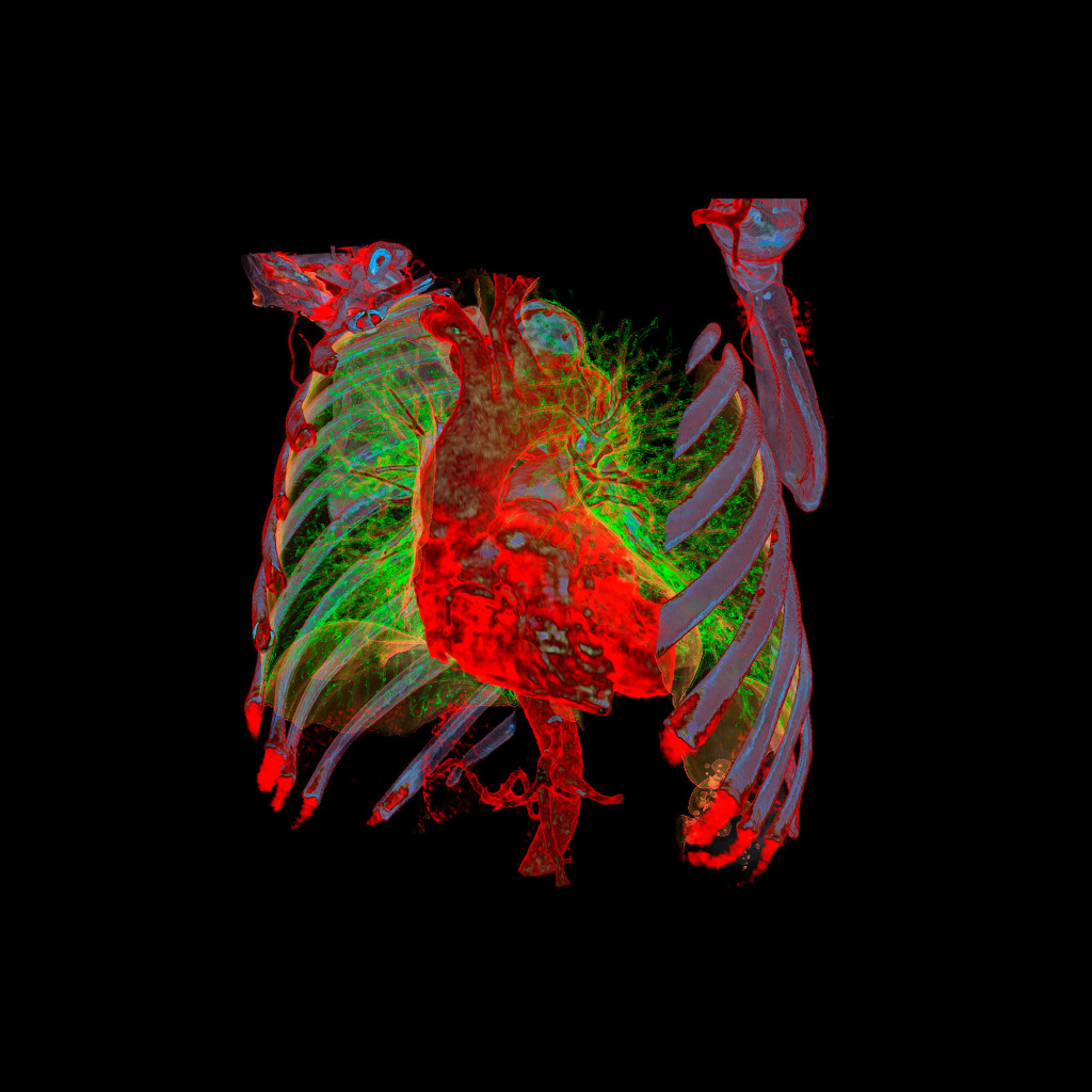 Aortic aneurysm, 3D CT scan