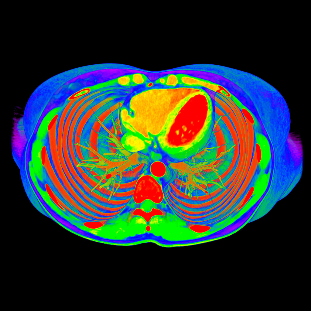 Heart, ribs and lungs, axial CT scan