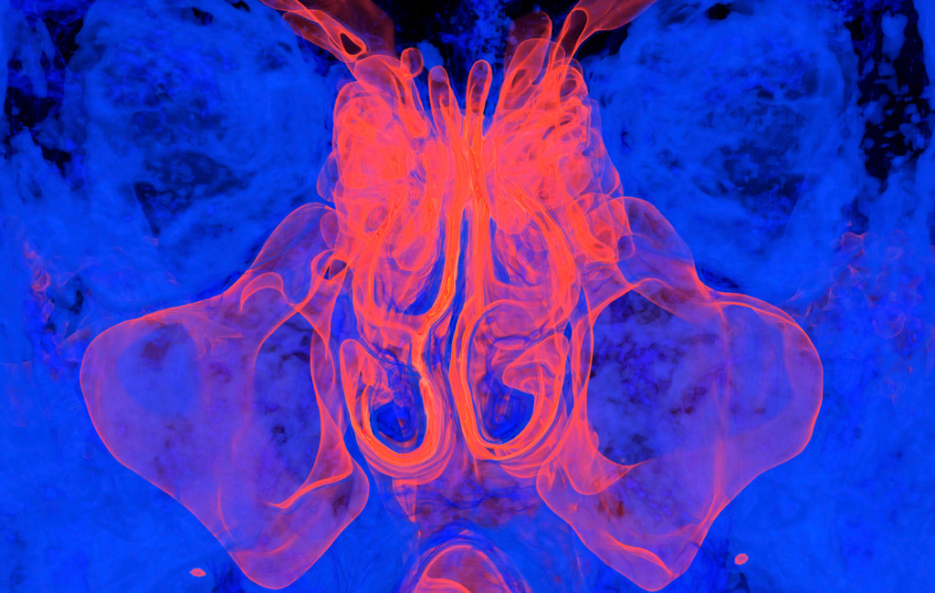 Paranasal sinuses, 3D CT scan