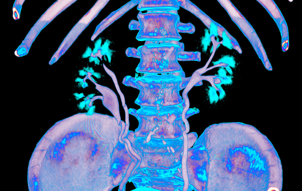Kidneys and duplicated ureter, CT scan