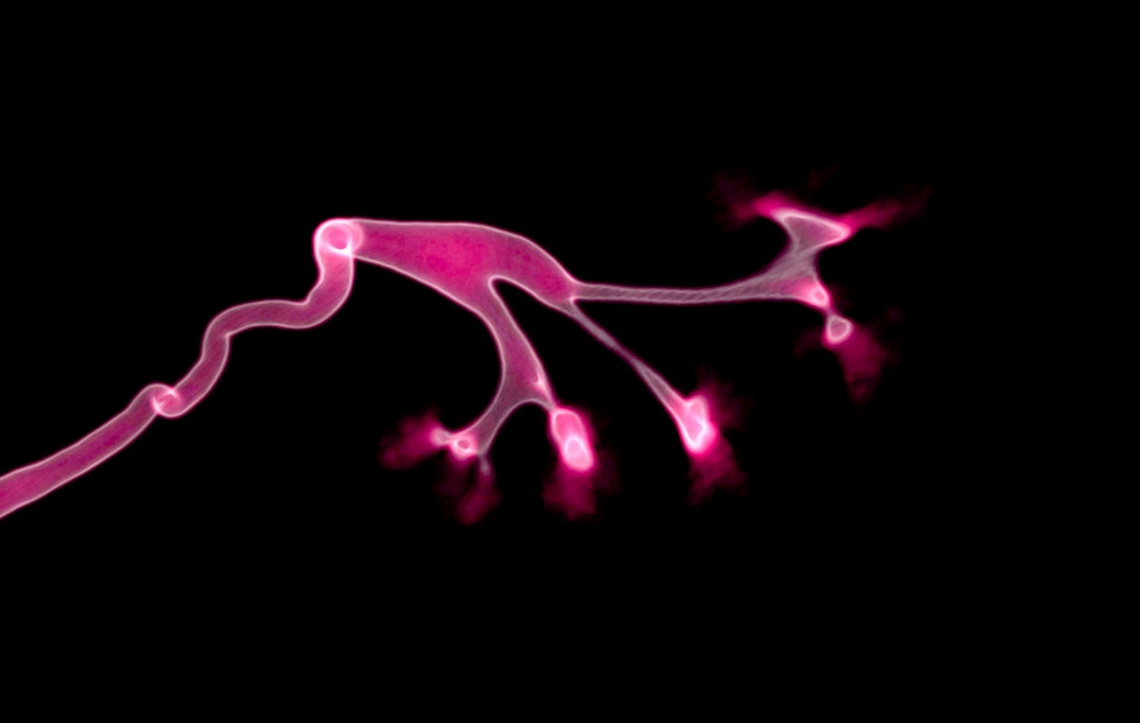 Urinary excretion from kidney, CT scan