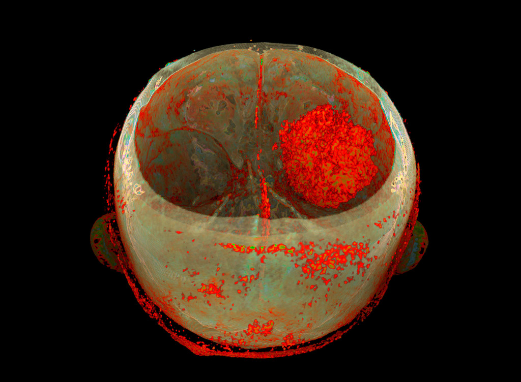 Intraparenchymal haemorrhage, CT scan