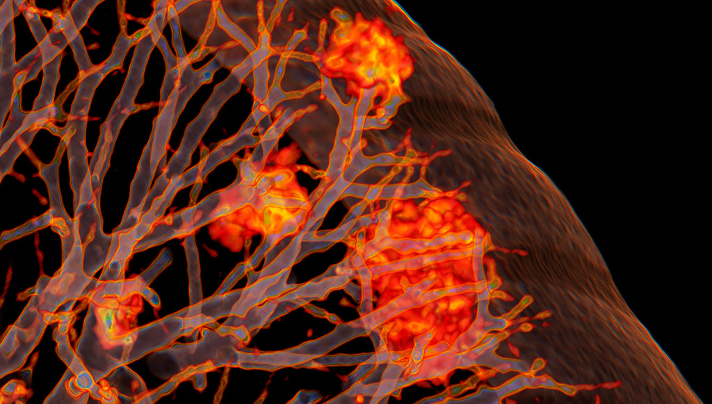 Lung affected by Covid-19 pneumonia, 3D CT scan