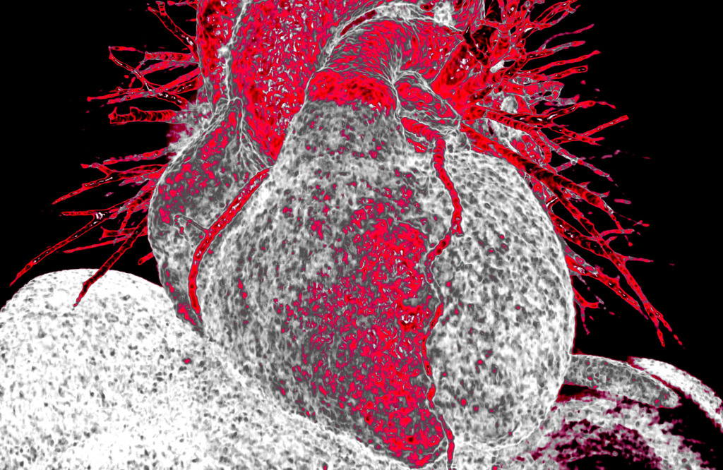Healthy heart, 3D CT scan