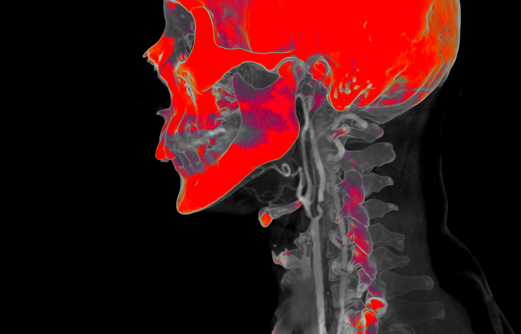 Blocked carotid artery, CT angiogram