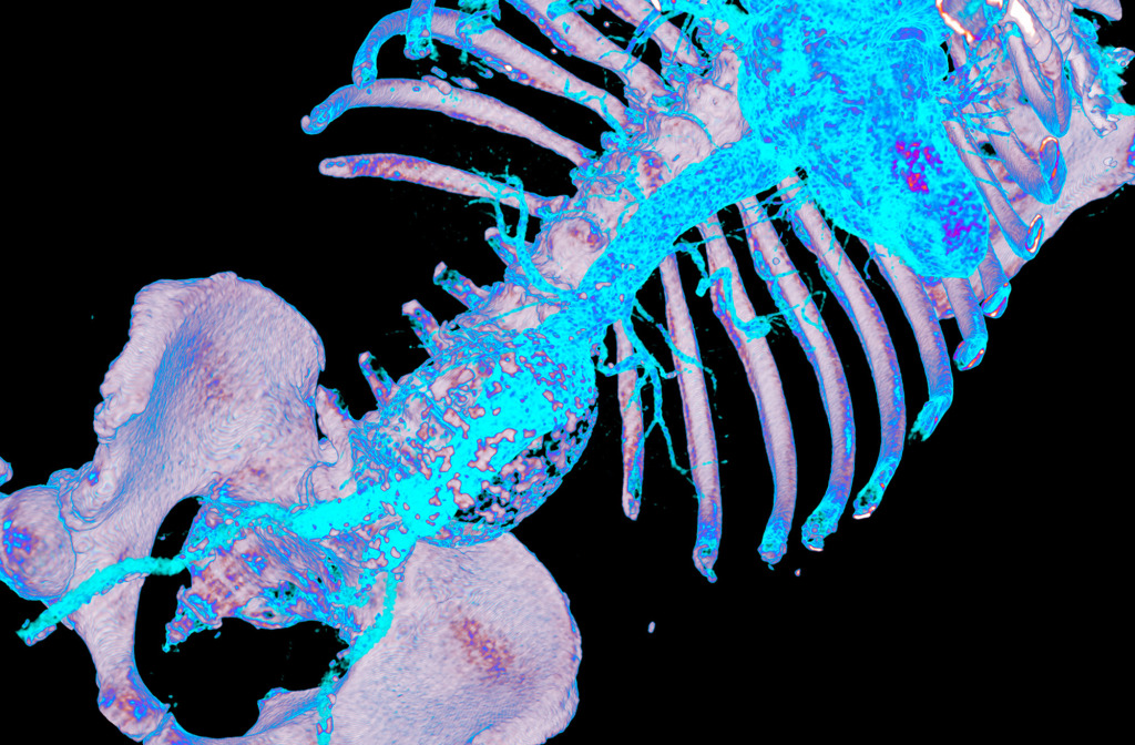 Aortic aneurysm, 3D CT scan
