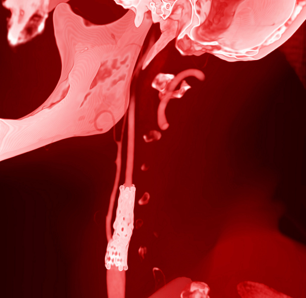 Arterial stent, CT scan