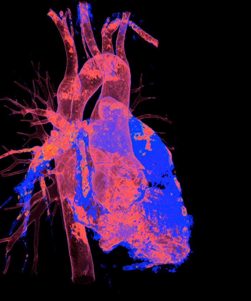 Kommerell diverticulum, 3D CT scan