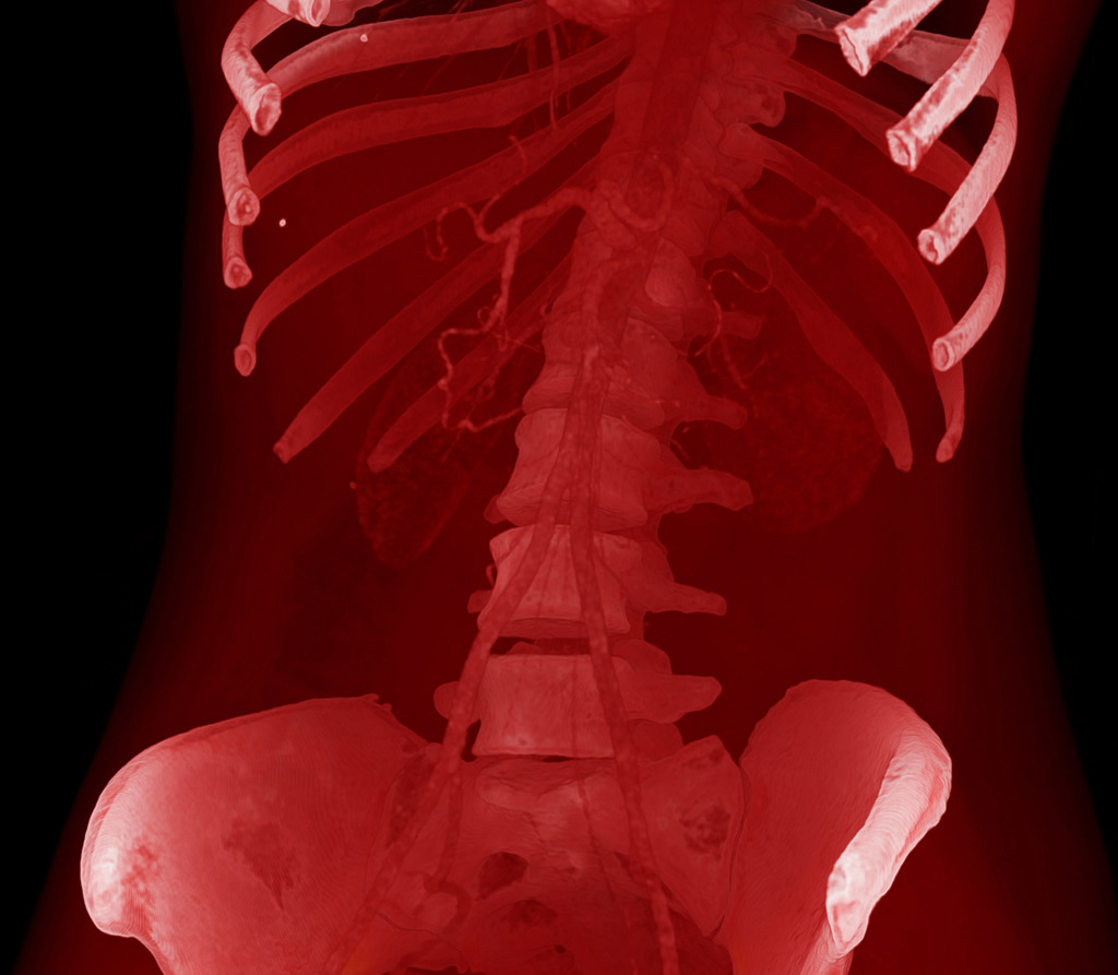 Abdominal aorta, 3D CT scan