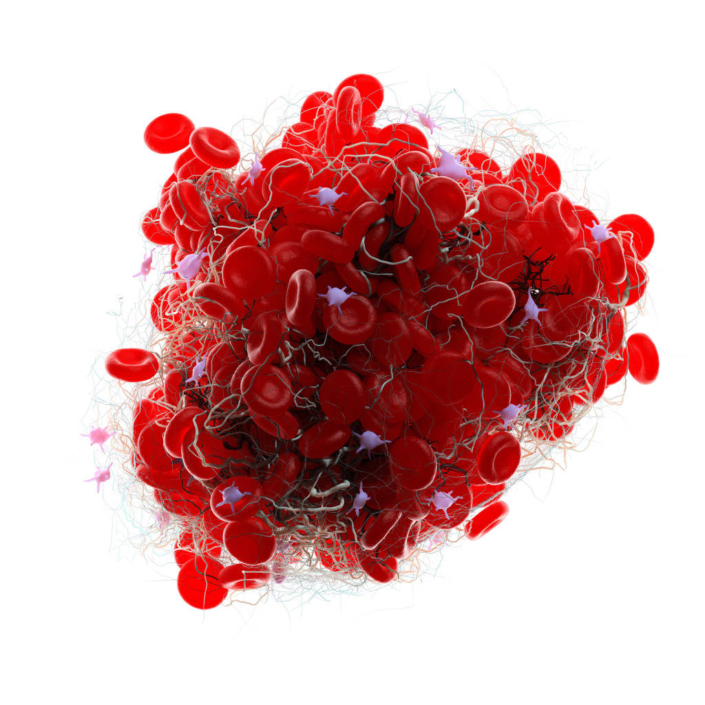 Blood clot, illustration