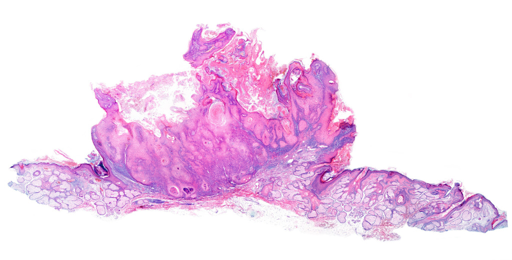 Actinic keratosis, light micrograph